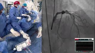Live Case #3 - LAD/D1 Bifurcation PCI using Mini-Crush and RA