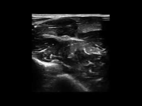 Median nerve · B-mode · L10 · Linear probe scan preview