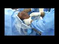 Plcmodified larsonacl reconstruction by dr  roshan wade  stanley medical college