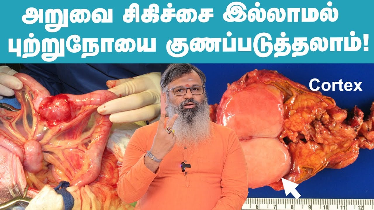 Cancer -ன் 3 முக்கிய அறிகுறிகள் !  What Are The Signs of Cancer ? (Part-2) - Dr.Gowtham Explains