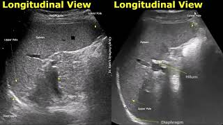Spleen Ultrasound Longitudinal View Labelled Anatomy | Upper Pole, Lower Pole, Hilum, Splenic Vein
