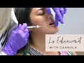 Dermal lip filler demo with cannula  skin by lovely