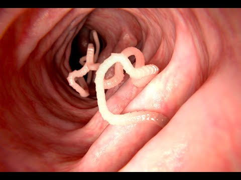 Video: Pinworms - Come Appaiono E Parassitano Gli Ossiuri Nel Corpo Umano