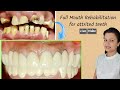 full mouth rehabilitation for attrited teeth | full mouth crowns preparation | Transformation - 3