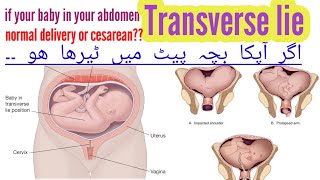 transverse baby| shoulder presentation|