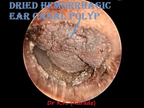 fungus clean.com Ear Removal Oto Dried Hemorrhagic Polyp endoscopic Canal fungus clean.com Ear Removal Oto Dried Hemorrhagic Polyp endoscopic Canal