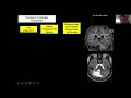 Pediatric neuroradiology lecutres posterior fossa malformations in children dr felice darco