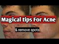 How to remove acne overnight magical treatment for acne or spots  healthy tips with eshaal noor