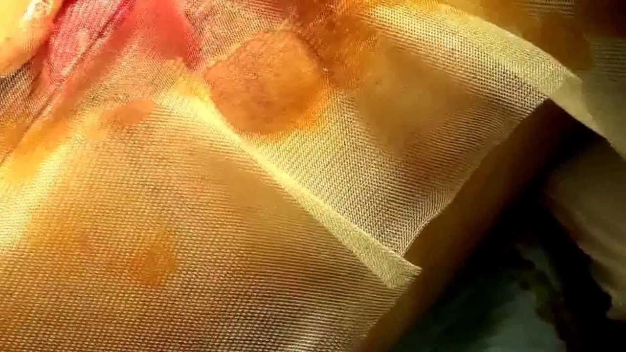 POST TRAUMATIC RESHAPING OF A LEG TRAUMA SCAR WITH MUSCULAR HERNIA