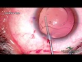 Easy removal of ipcl with hook technique at sharp sight  doctor kamal b kapur kbkapur