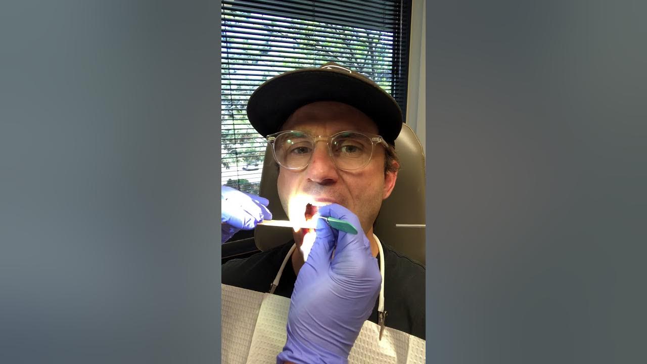 marsupialization-of-oral-ranula-aka-removing-bubble-under-tongue-youtube