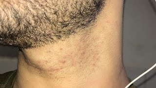 How To Get Rid Of Razor Bumps Step By Step At Home