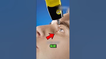 Got Super Glue in Your Eye? 😱 Don’t Do This — Here’s How to Fix It Safely