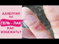 АЛЛЕРГИЯ на гель лак | Вся правда о гипоаллергенных базах