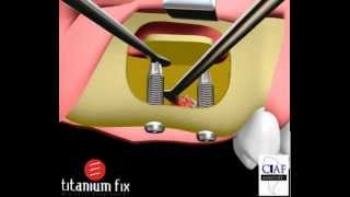 Enxerto - Levantamento De Seio Da Face Com Implantes Imediatos