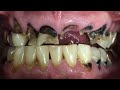 Meth Mouth - A Dentist's Worst Nightmare (Can It Be Treated?)