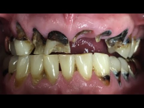 Meth Mouth - A Dentist's Worst Nightmare (Can It Be Treated?) - YouTube