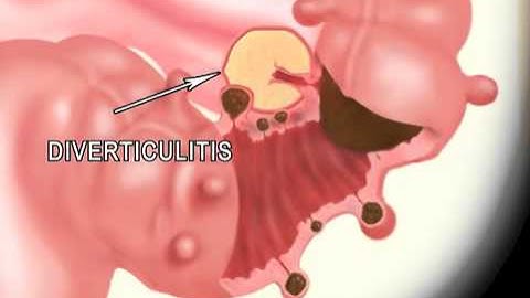Diverticulitis Meditoons™