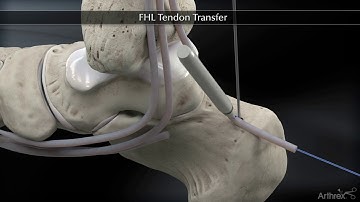 Flexor Hallucis Longus FHL Tendon Transfer