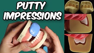 Temp Crown Impressions - VPS Putty Dental