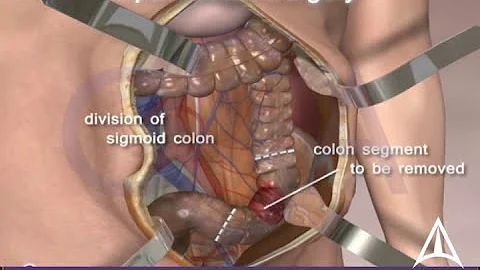 Colorectal cancer surgery - Open procedure - 3D an...