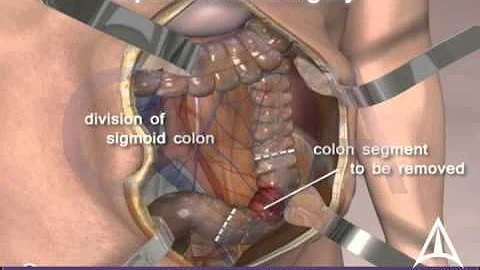Colorectal cancer surgery - Open procedure - 3D animation - DayDayNews