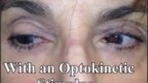 Aberrant regeneration of the third cranial nerve