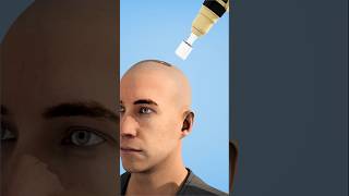 Brain surgery 🧠#ai #surgeryrecovery #Brain