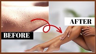 How to Get Rid of Keratosis Pilaris in Just a few Days | Get that glowy skin💫