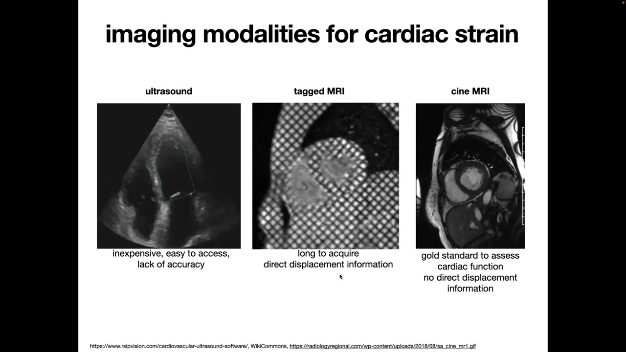 Global longitudinal strain: A new gold standard for assessing