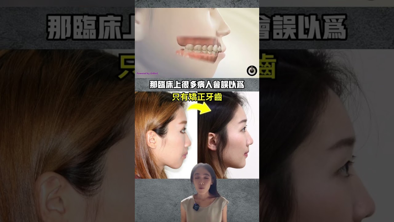 牙套換臉術#牙齒矯正#嘴凸#下巴後縮