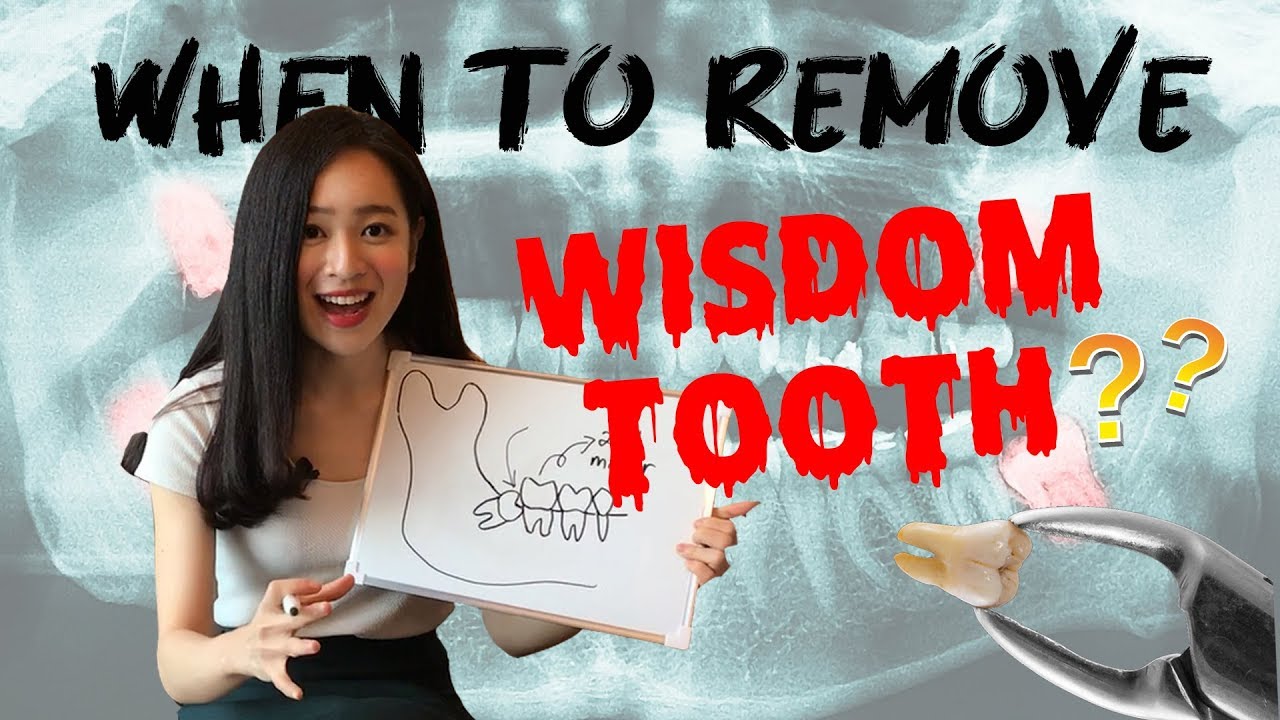 Dangers Of Wisdom Tooth Removal? | Ask Me Anything!