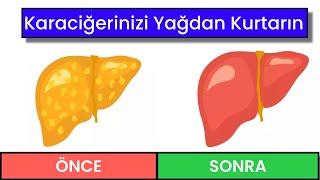 Karaciğerinizi Yağdan Arındırın | Karaciğer Yağlanması | Karaciğer Yağlanmasına Ne İyi Gelir