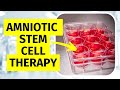 Amniotic Stem Cell Therapy for Knee Arthritis