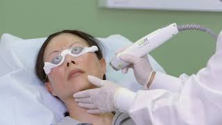 Laser Genesis Melasma Treatment - Remove Melasma, Rosacea, and Redness Therapy