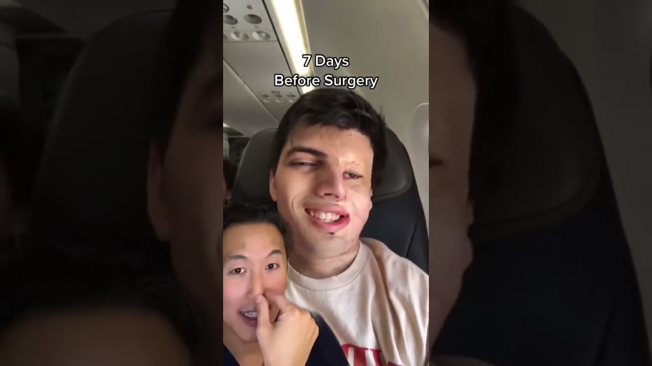 Countdown To Nasal Reconstruction Surgery Shorts Nasalreconstruction