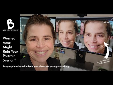 Worried Blemishes or Acne Might Ruin Your Portrait Session?  Watch This!