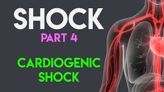 Cardiogenic Shock | Shock (Part 4)