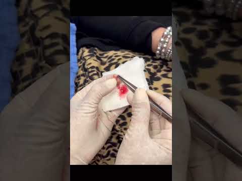 A SWEET GEM CYST ON THE FACE