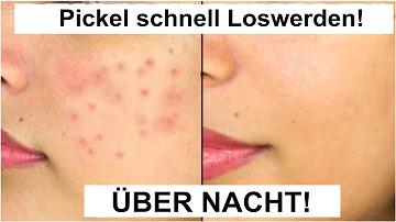 Wie bekommt man Pickel für immer weg?