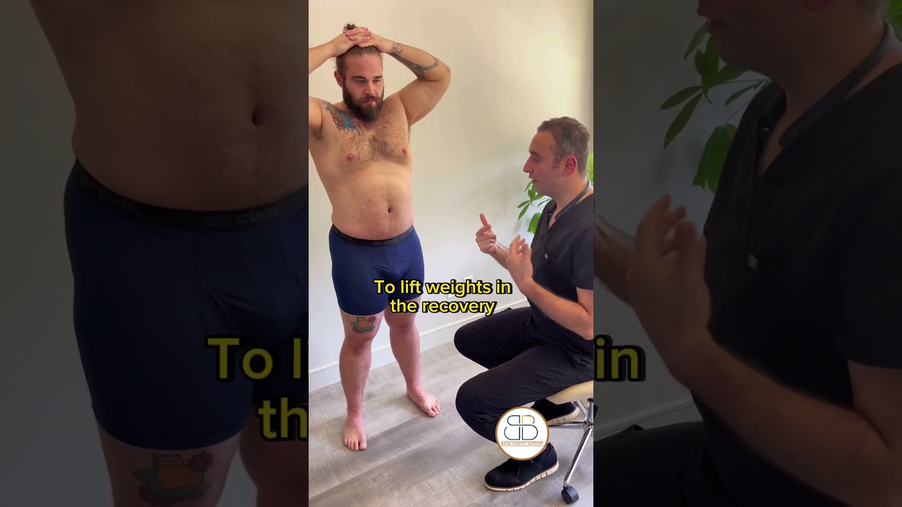 1 year after a tummy tuck and lipo by Dr. Batal!👏 