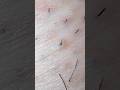 長め動画です #hairremoval #blackheads #tweezers #extraction #ingrownhair #毛抜き