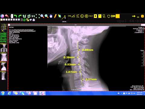 20/20 Imaging Opal-Rad (Chiropractic) George's Line Tool - video from 20/20 Imaging