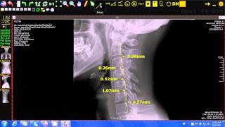 20/20 Imaging Opal-Rad (Chiropractic) George's Line Tool