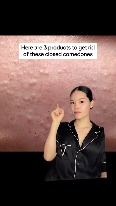Products to get rid of Closed comedones #closedcomedones #whiteheadsremoval #retinal #differing