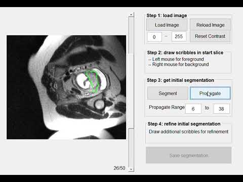 A demo video of SlicSeg for interactive segmentation