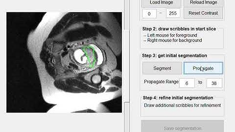 A demo video of SlicSeg for interactive segmentation