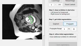 A demo video of SlicSeg for interactive segmentation