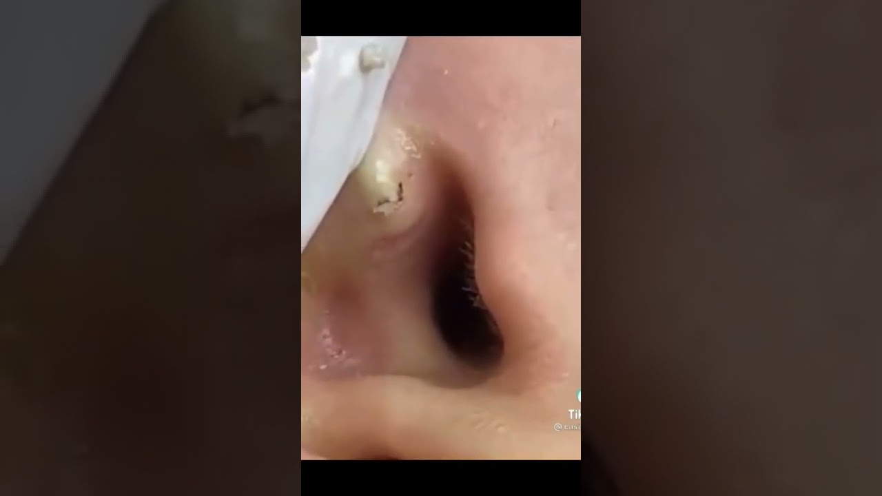 Pickel Ausdrücken Blackheads und Mitesser entfernen 🔴 70