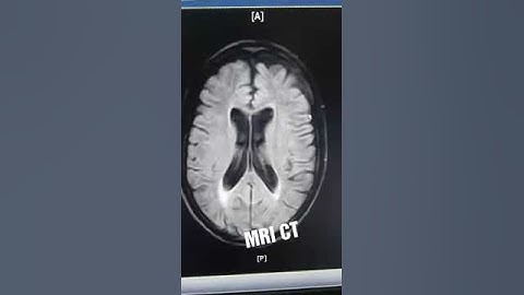 Normal BRAIN MRI image